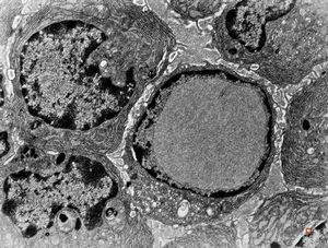 M, | intranuclear inclusion - plasmocyte, tonsilla palatina M, | intranuclear inclusion - plasmocyte, tonsilla palatina